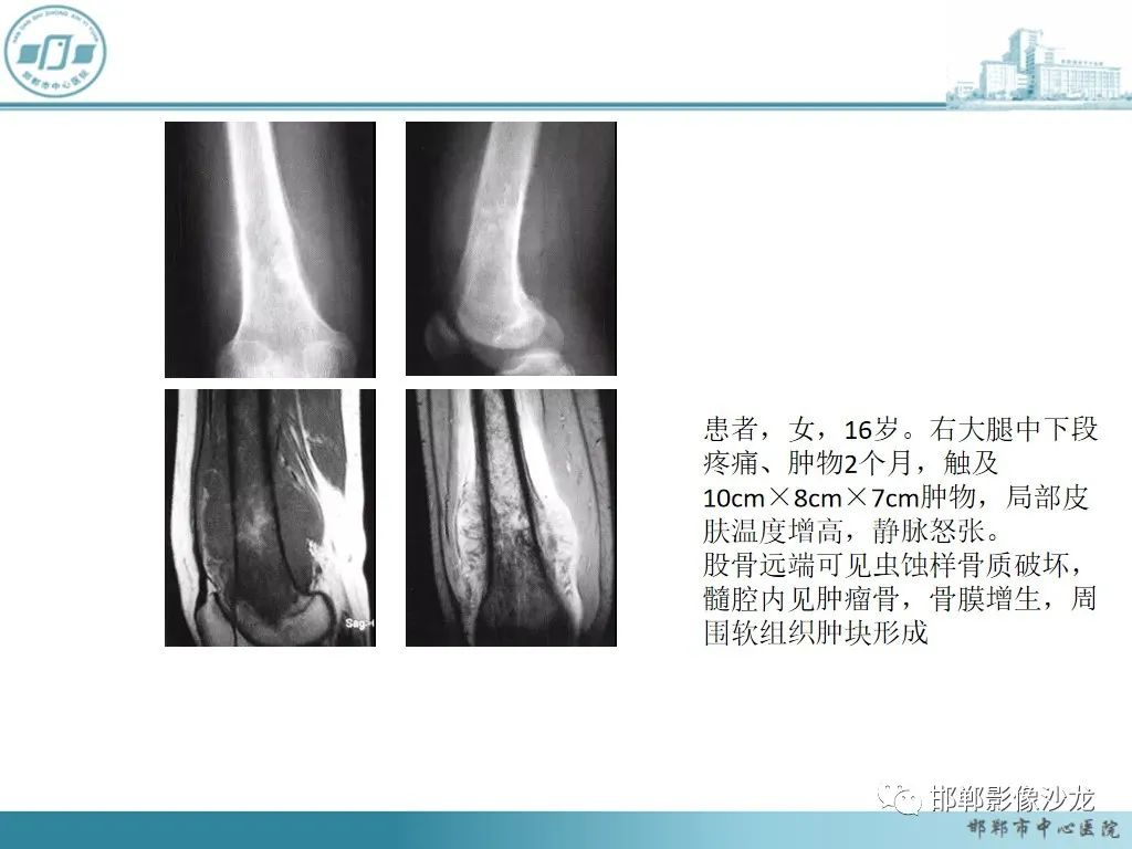 影像PPT - 【PPT】病例分析—原发性骨淋巴瘤-33 影像PPT - 【PPT】病例分析—原发性骨淋巴瘤-33
