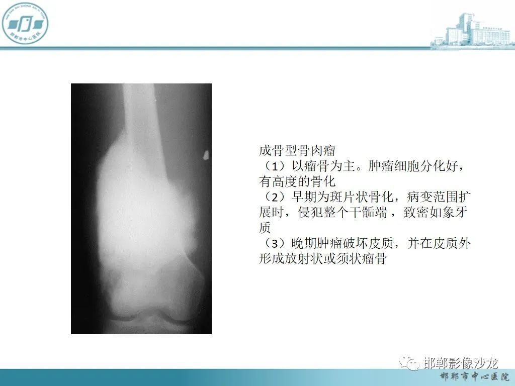 影像PPT - 【PPT】病例分析—原发性骨淋巴瘤-34 影像PPT - 【PPT】病例分析—原发性骨淋巴瘤-34