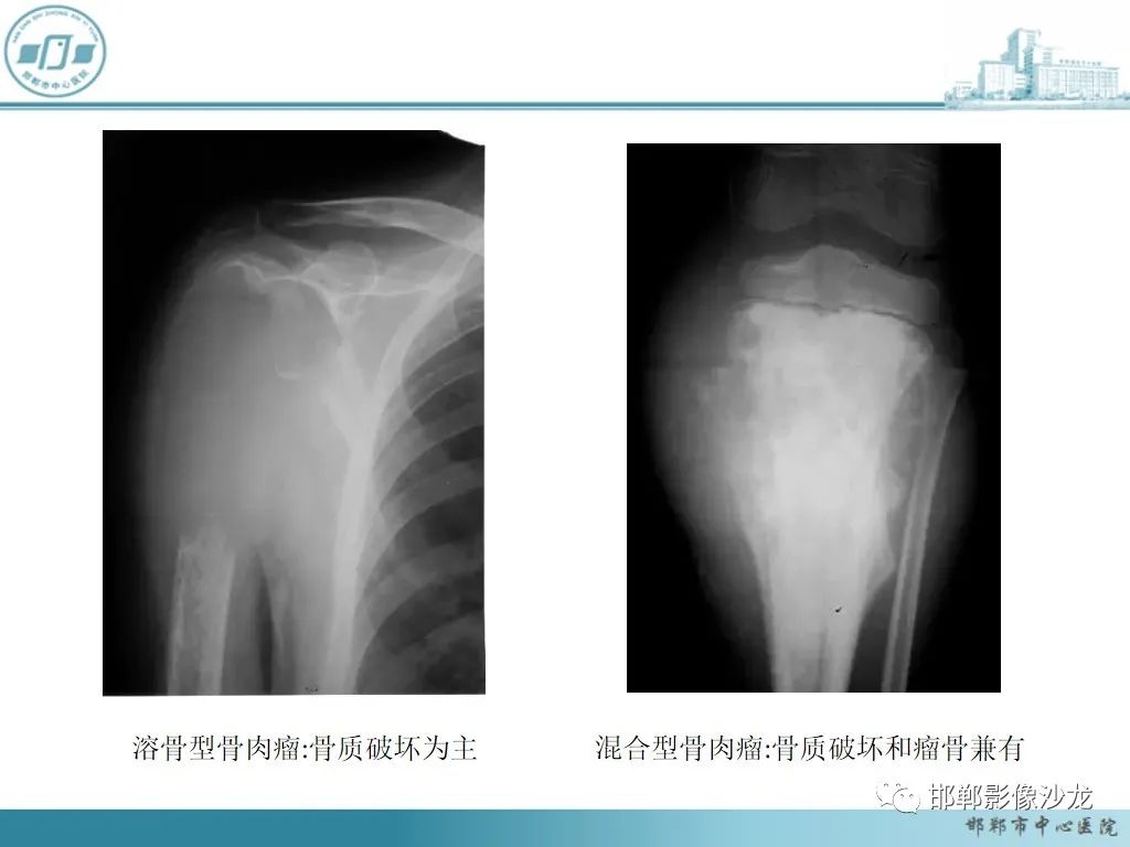 影像PPT - 【PPT】病例分析—原发性骨淋巴瘤-35 影像PPT - 【PPT】病例分析—原发性骨淋巴瘤-35