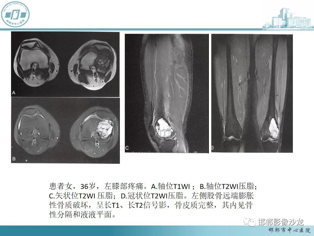 影像PPT - 【PPT】病例分析—原发性骨淋巴瘤-37 影像PPT - 【PPT】病例分析—原发性骨淋巴瘤-37