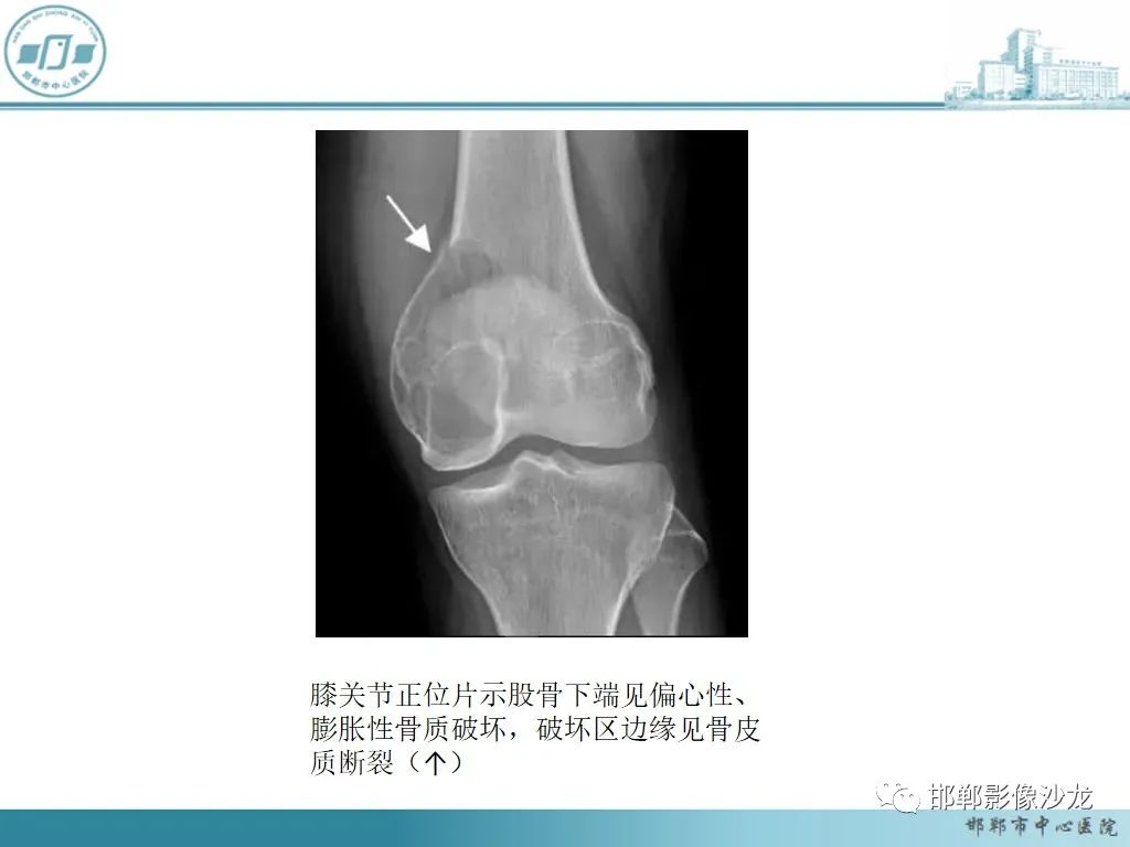 影像PPT - 【PPT】病例分析—原发性骨淋巴瘤-38 影像PPT - 【PPT】病例分析—原发性骨淋巴瘤-38