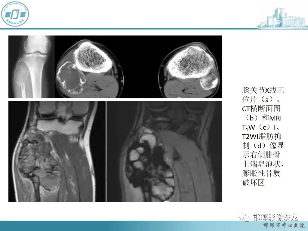 影像PPT - 【PPT】病例分析—原发性骨淋巴瘤-39 影像PPT - 【PPT】病例分析—原发性骨淋巴瘤-39