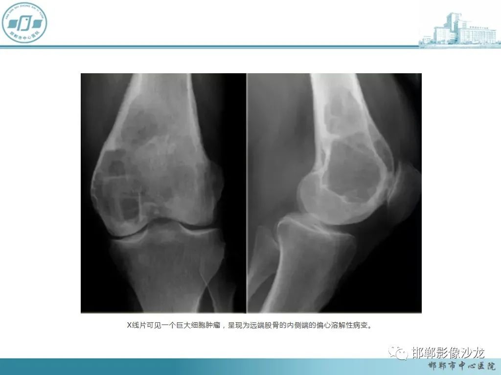 影像PPT - 【PPT】病例分析—原发性骨淋巴瘤-40 影像PPT - 【PPT】病例分析—原发性骨淋巴瘤-40