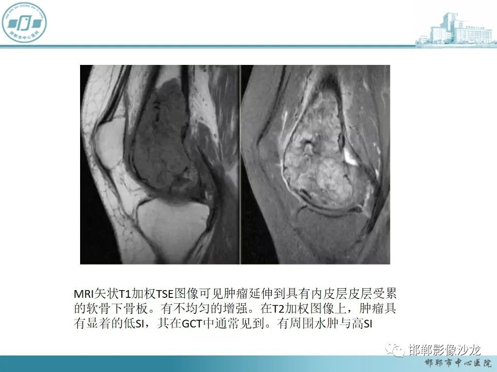 影像PPT - 【PPT】病例分析—原发性骨淋巴瘤-41 影像PPT - 【PPT】病例分析—原发性骨淋巴瘤-41