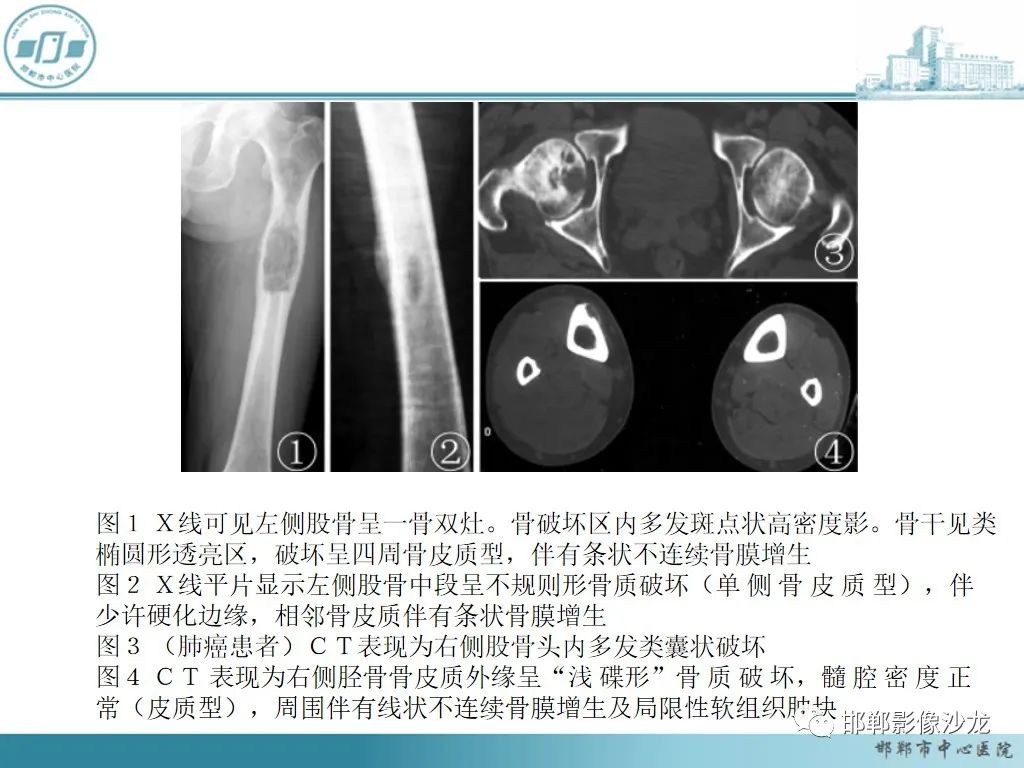 影像PPT - 【PPT】病例分析—原发性骨淋巴瘤-43 影像PPT - 【PPT】病例分析—原发性骨淋巴瘤-43