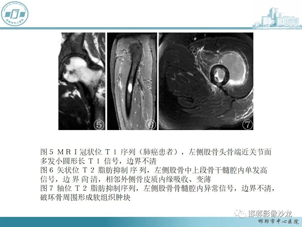 影像PPT - 【PPT】病例分析—原发性骨淋巴瘤-44 影像PPT - 【PPT】病例分析—原发性骨淋巴瘤-44