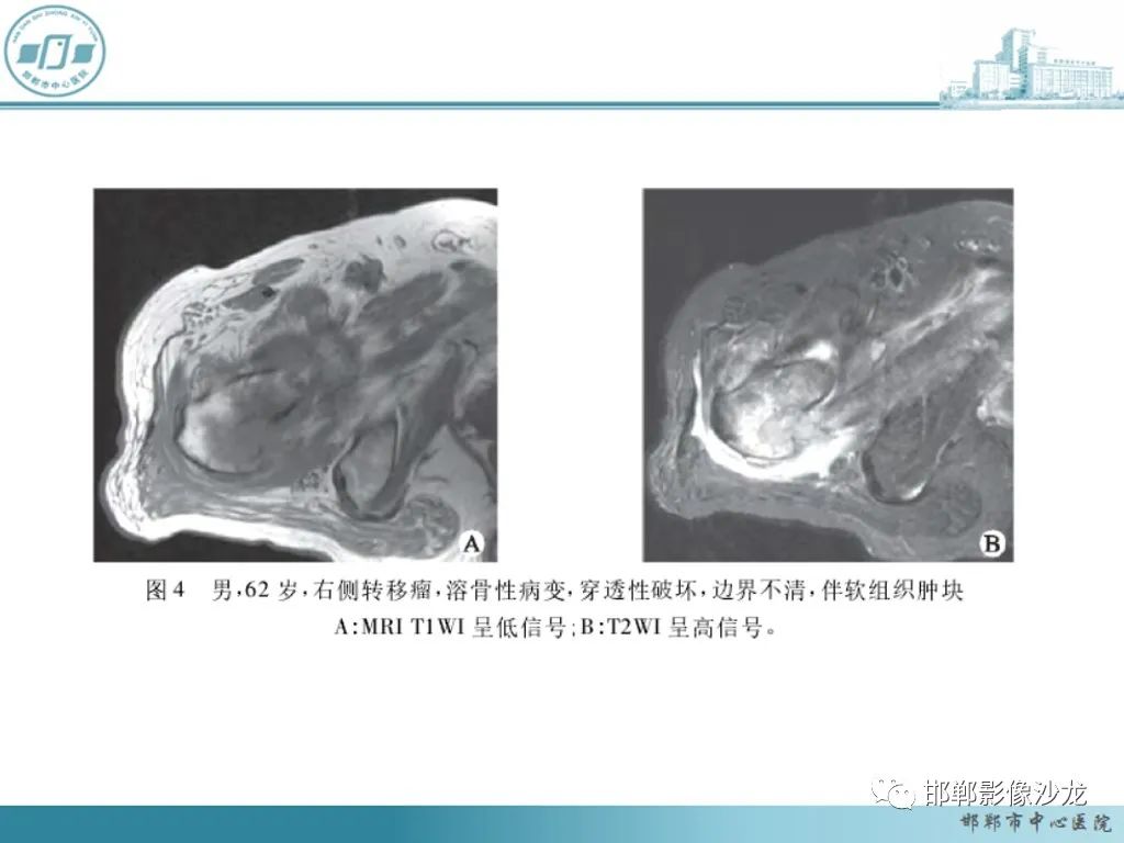 影像PPT - 【PPT】病例分析—原发性骨淋巴瘤-45 影像PPT - 【PPT】病例分析—原发性骨淋巴瘤-45