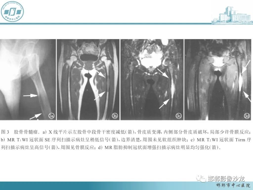 影像PPT - 【PPT】病例分析—原发性骨淋巴瘤-47 影像PPT - 【PPT】病例分析—原发性骨淋巴瘤-47
