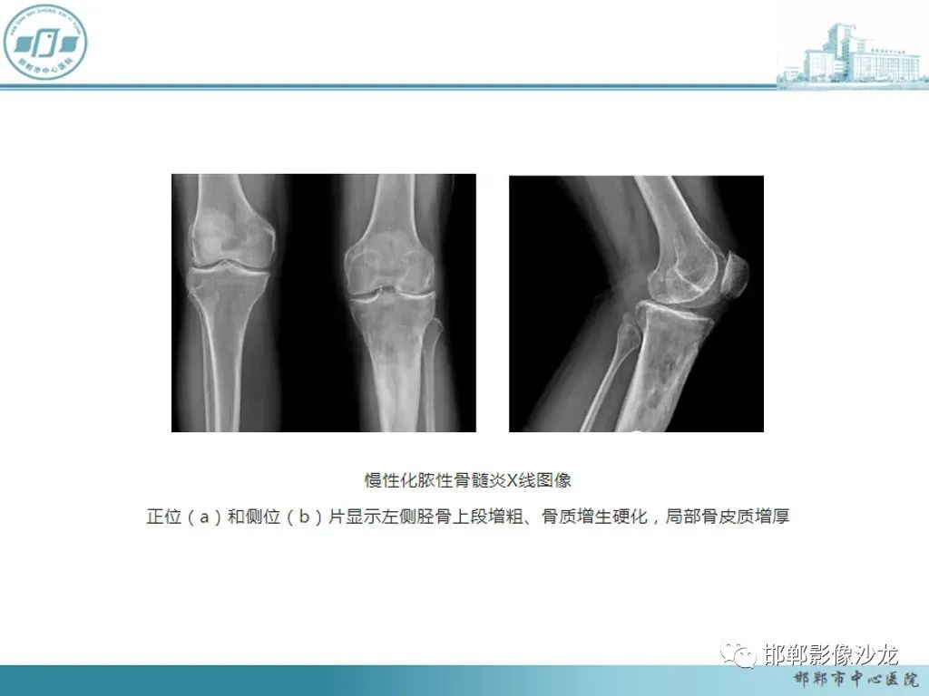影像PPT - 【PPT】病例分析—原发性骨淋巴瘤-49 影像PPT - 【PPT】病例分析—原发性骨淋巴瘤-49
