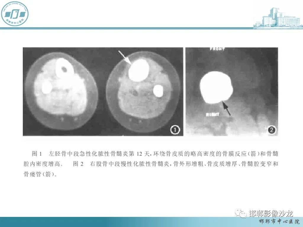 影像PPT - 【PPT】病例分析—原发性骨淋巴瘤-50 影像PPT - 【PPT】病例分析—原发性骨淋巴瘤-50