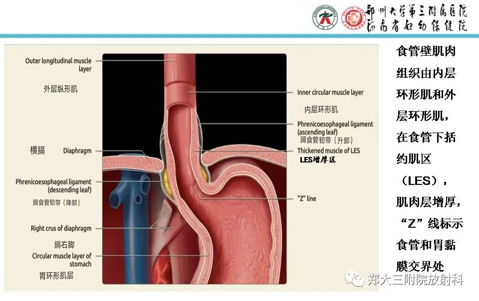 影像PPT - 【PPT】食管裂孔疝的影像表现-8