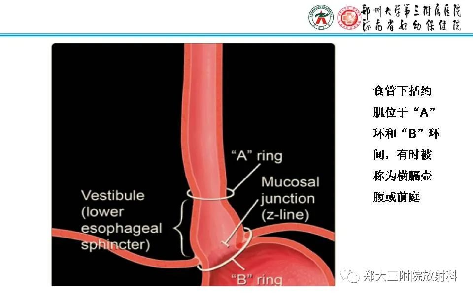 影像PPT - 【PPT】食管裂孔疝的影像表现-9
