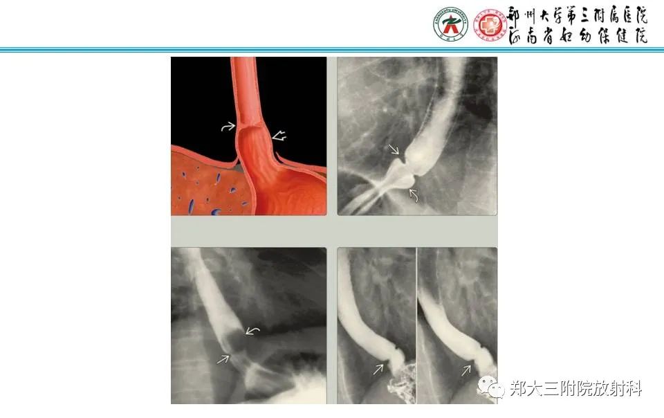 影像PPT - 【PPT】食管裂孔疝的影像表现-12