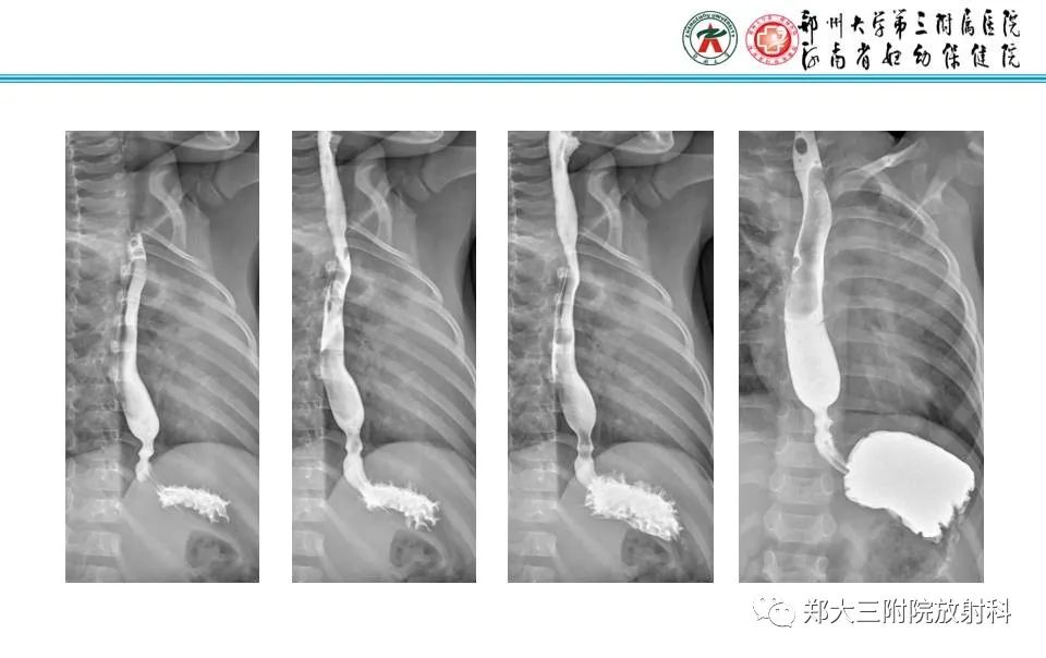 影像PPT - 【PPT】食管裂孔疝的影像表现-3