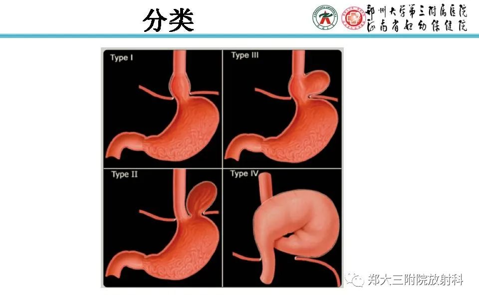影像PPT - 【PPT】食管裂孔疝的影像表现-16
