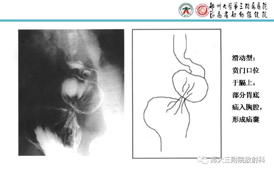 影像PPT - 【PPT】食管裂孔疝的影像表现-32