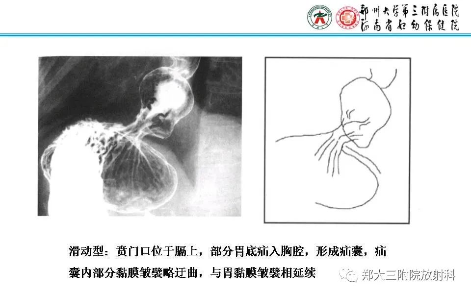 影像PPT - 【PPT】食管裂孔疝的影像表现-33