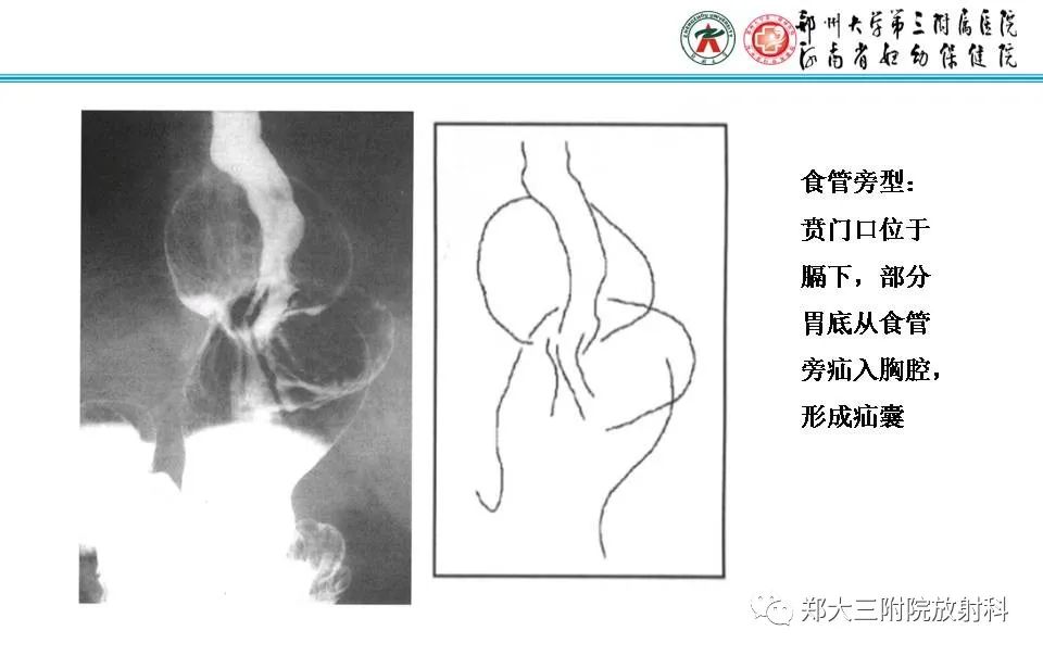 影像PPT - 【PPT】食管裂孔疝的影像表现-34