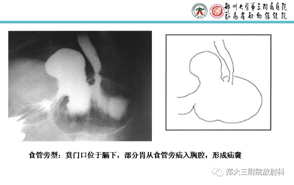 影像PPT - 【PPT】食管裂孔疝的影像表现-35