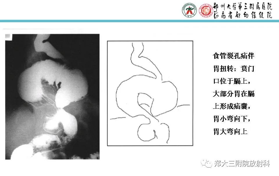 影像PPT - 【PPT】食管裂孔疝的影像表现-36
