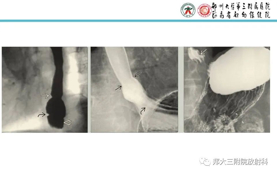 影像PPT - 【PPT】食管裂孔疝的影像表现-37