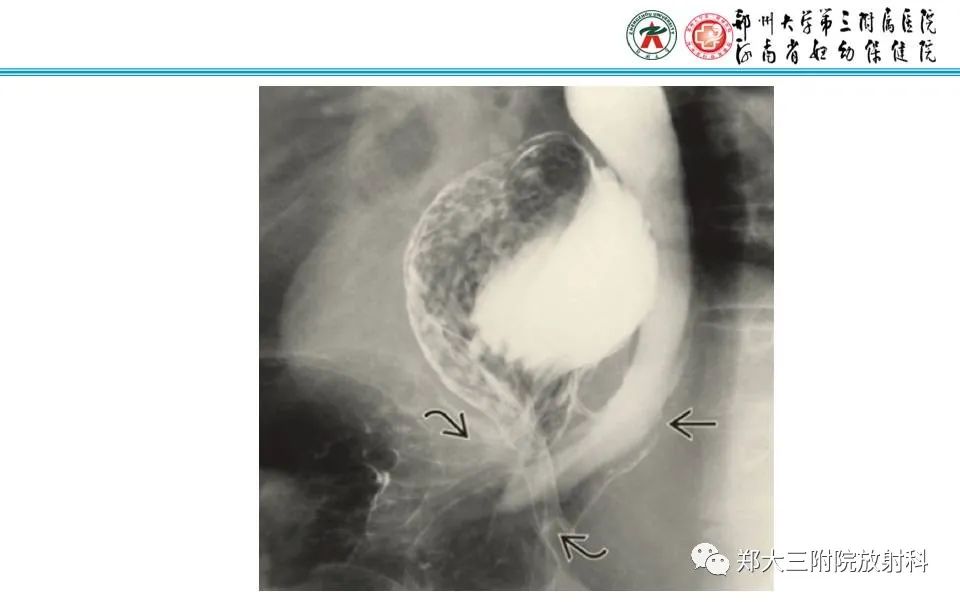 影像PPT - 【PPT】食管裂孔疝的影像表现-38
