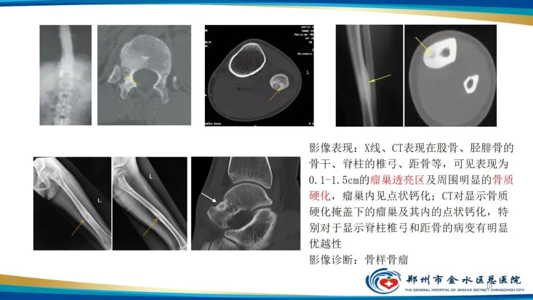 影像PPT - 【PPT】良性骨肿瘤的诊断及鉴别诊断-10