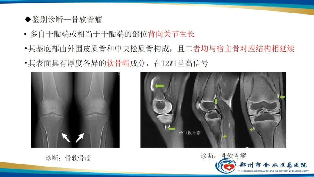 影像PPT - 【PPT】良性骨肿瘤的诊断及鉴别诊断-7