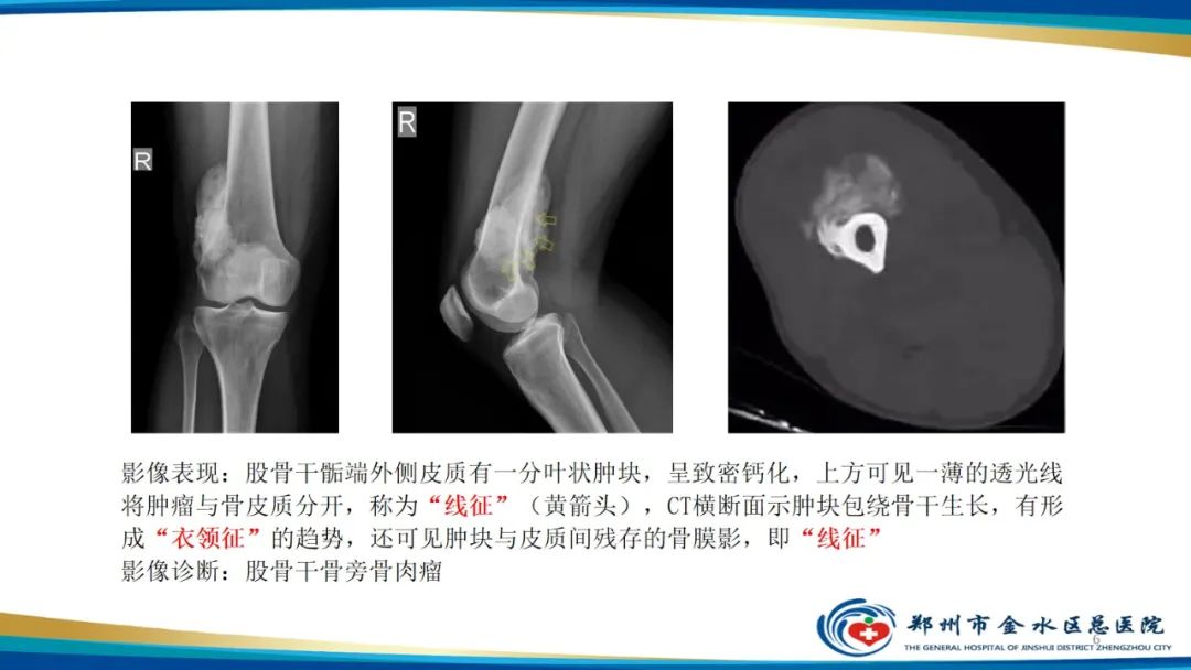 影像PPT - 【PPT】良性骨肿瘤的诊断及鉴别诊断-6