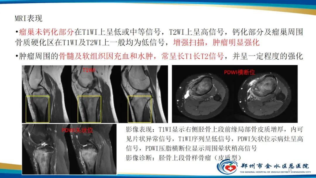 影像PPT - 【PPT】良性骨肿瘤的诊断及鉴别诊断-11