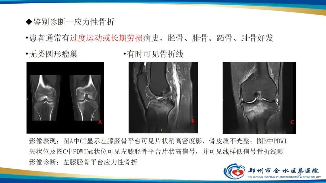 影像PPT - 【PPT】良性骨肿瘤的诊断及鉴别诊断-12