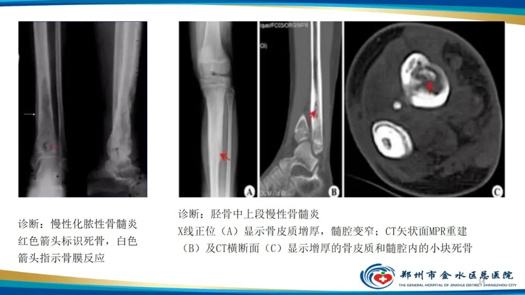 影像PPT - 【PPT】良性骨肿瘤的诊断及鉴别诊断-14
