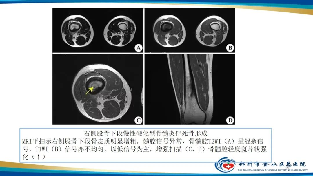 影像PPT - 【PPT】良性骨肿瘤的诊断及鉴别诊断-15