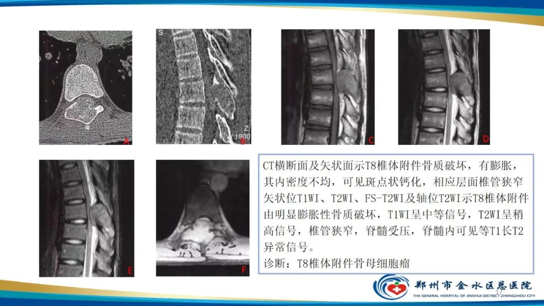 影像PPT - 【PPT】良性骨肿瘤的诊断及鉴别诊断-17