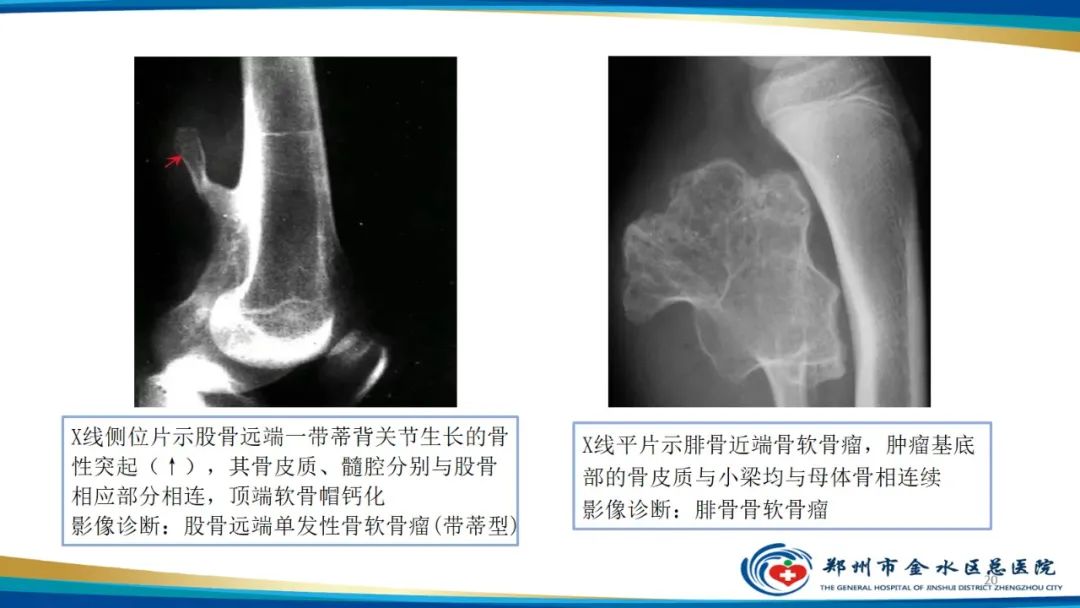 影像PPT - 【PPT】良性骨肿瘤的诊断及鉴别诊断-20
