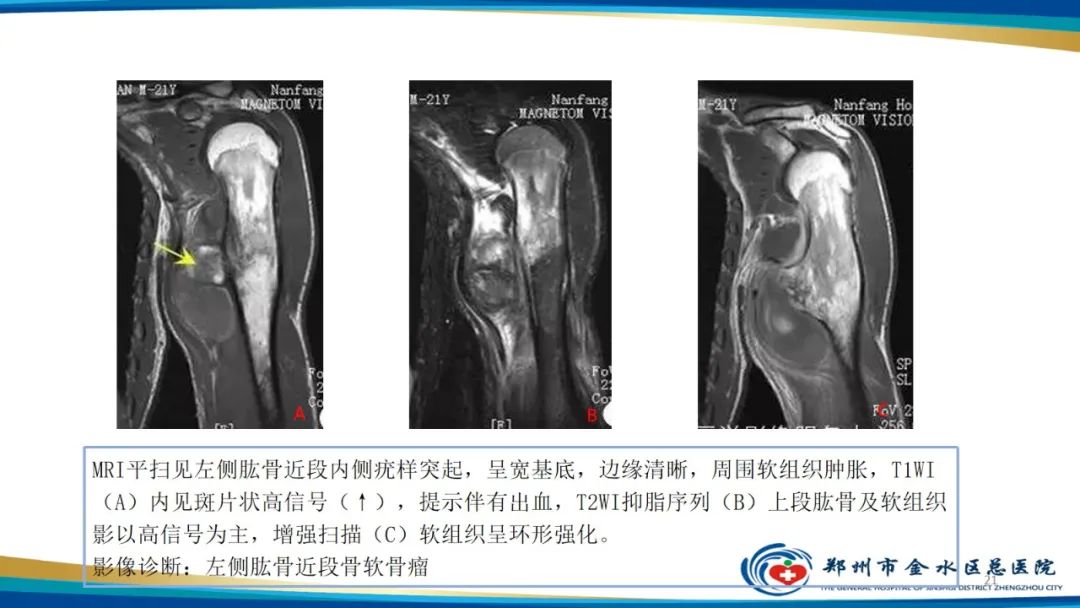 影像PPT - 【PPT】良性骨肿瘤的诊断及鉴别诊断-21