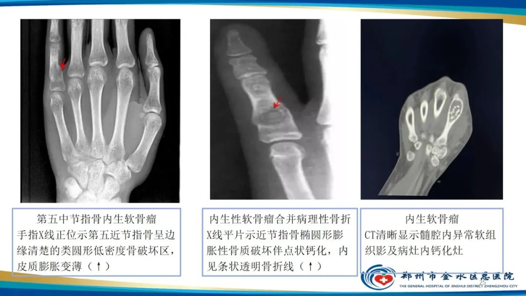 影像PPT - 【PPT】良性骨肿瘤的诊断及鉴别诊断-25