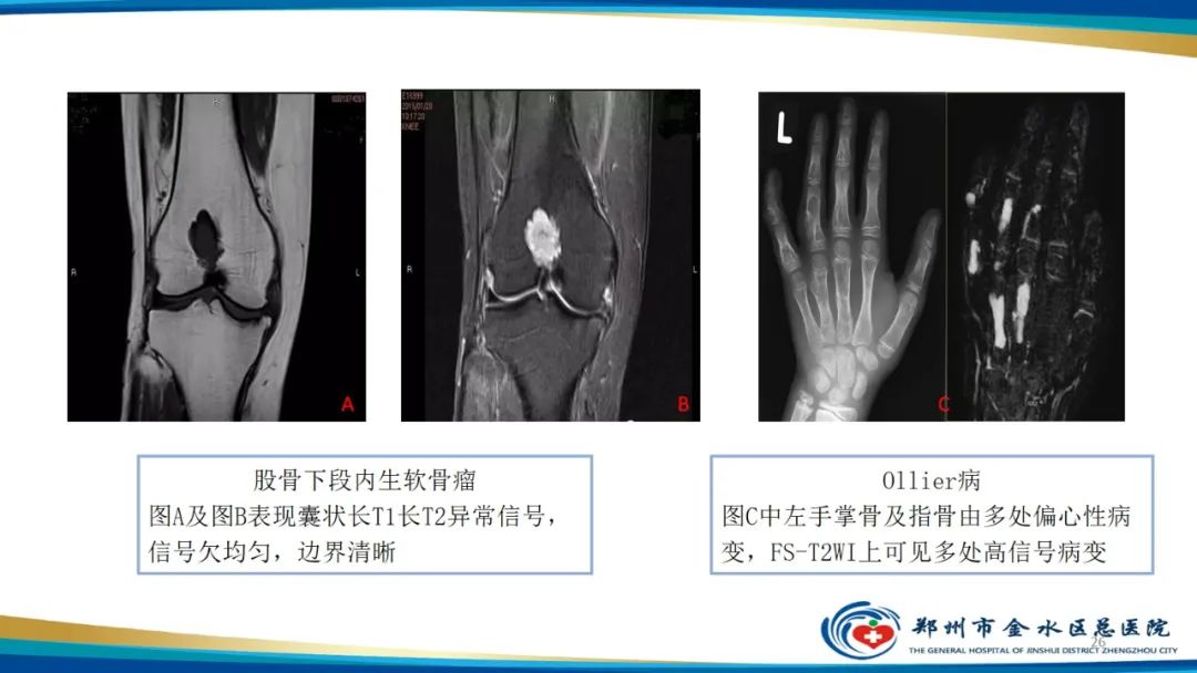 影像PPT - 【PPT】良性骨肿瘤的诊断及鉴别诊断-26