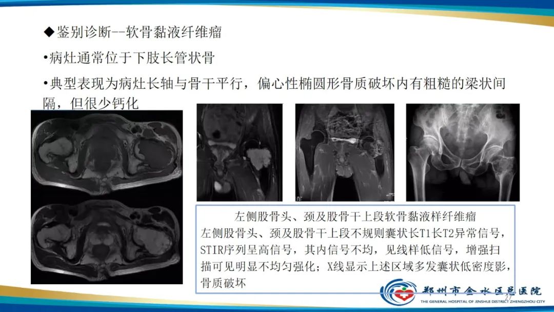 影像PPT - 【PPT】良性骨肿瘤的诊断及鉴别诊断-27