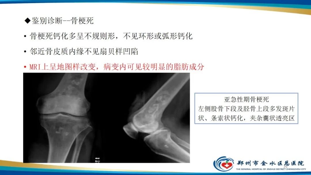 影像PPT - 【PPT】良性骨肿瘤的诊断及鉴别诊断-29