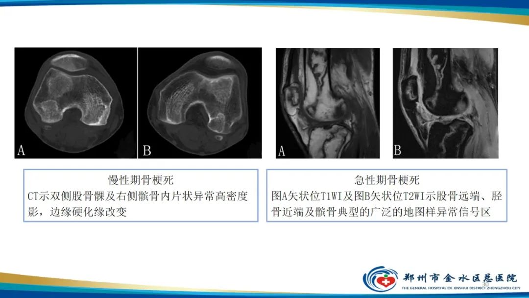 影像PPT - 【PPT】良性骨肿瘤的诊断及鉴别诊断-30