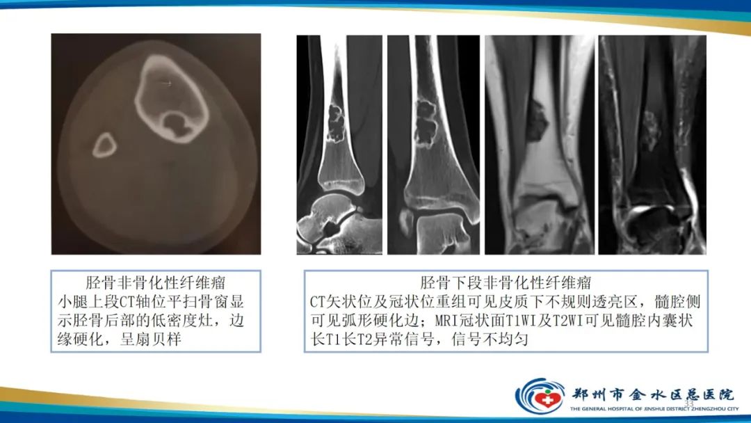 影像PPT - 【PPT】良性骨肿瘤的诊断及鉴别诊断-33