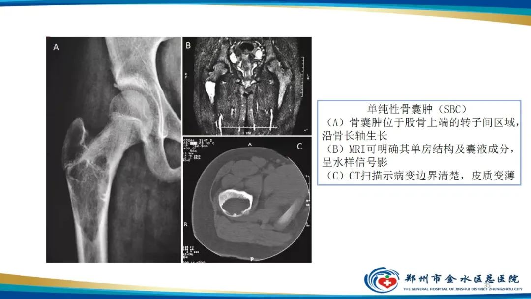 影像PPT - 【PPT】良性骨肿瘤的诊断及鉴别诊断-35