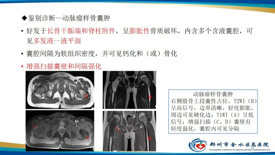影像PPT - 【PPT】良性骨肿瘤的诊断及鉴别诊断-36