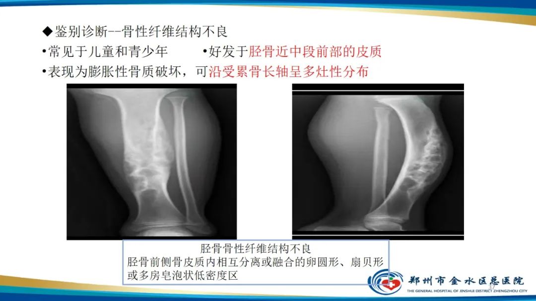 影像PPT - 【PPT】良性骨肿瘤的诊断及鉴别诊断-37