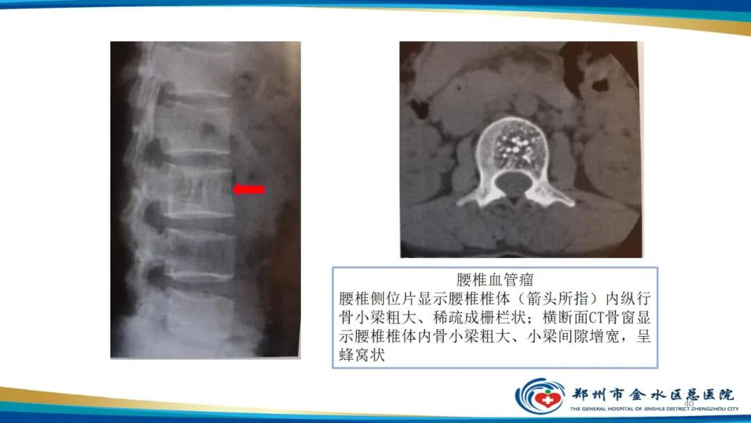 影像PPT - 【PPT】良性骨肿瘤的诊断及鉴别诊断-40