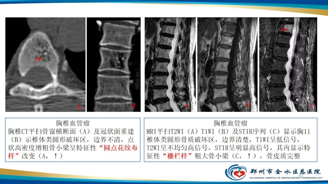 影像PPT - 【PPT】良性骨肿瘤的诊断及鉴别诊断-41