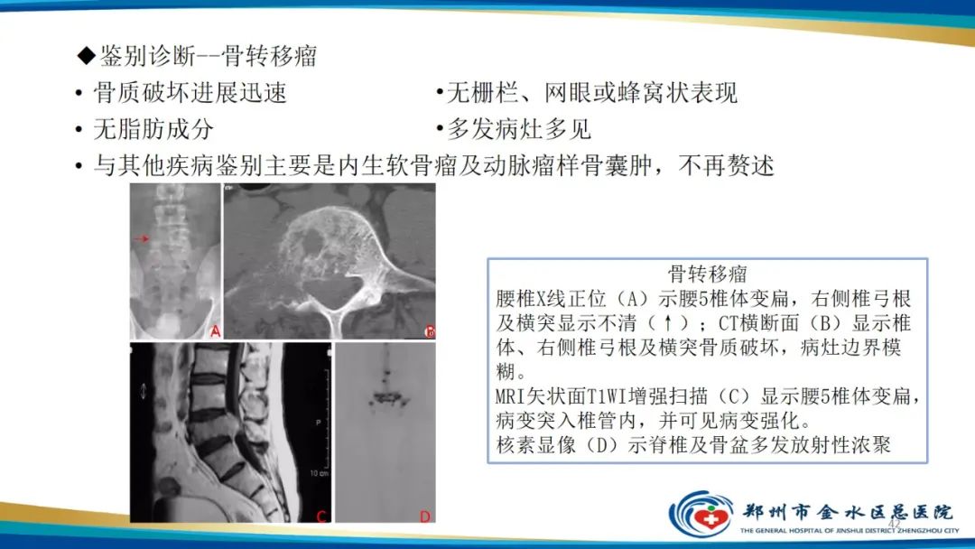 影像PPT - 【PPT】良性骨肿瘤的诊断及鉴别诊断-42