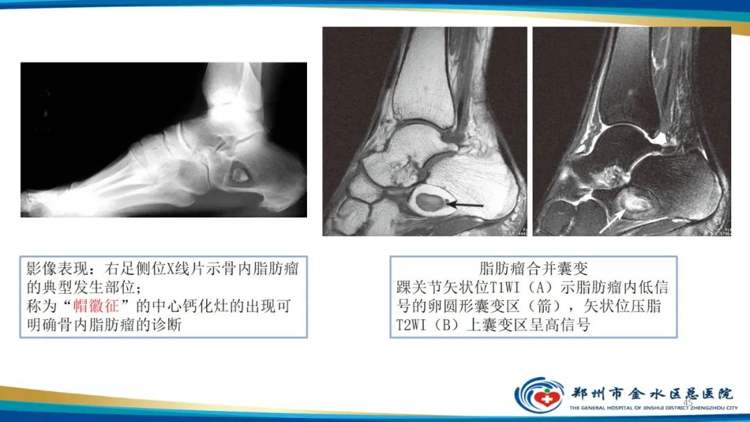 影像PPT - 【PPT】良性骨肿瘤的诊断及鉴别诊断-45