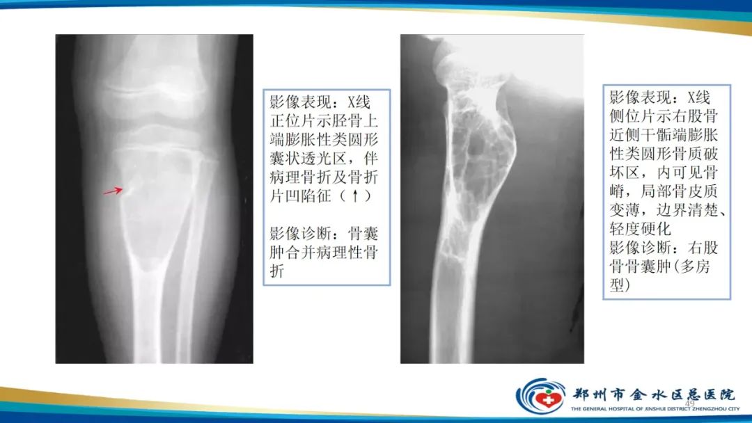 影像PPT - 【PPT】良性骨肿瘤的诊断及鉴别诊断-49
